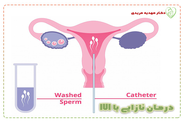 IUI - دکتر مهدیه مریدی