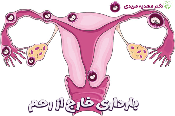 بارداری خارج از رحم