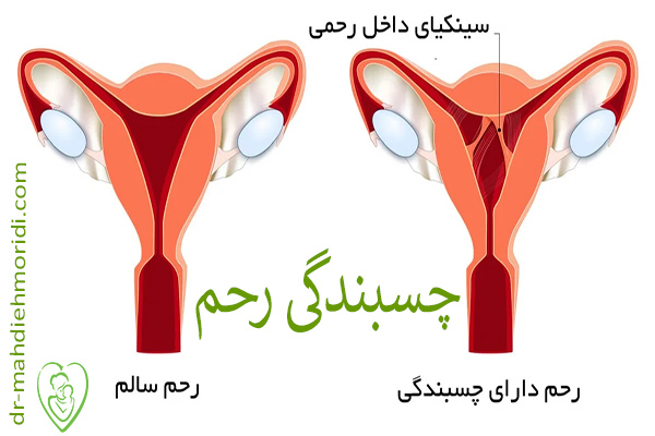 چسبندگی رحم - دکتر مهدیه مریدی