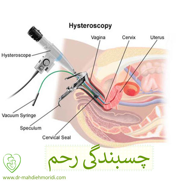 چسبندگی رحم - دکتر مهدیه مریدی