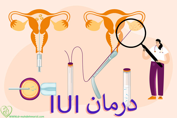 درمان IUI در لرستان - دکتر مهدیه مریدی