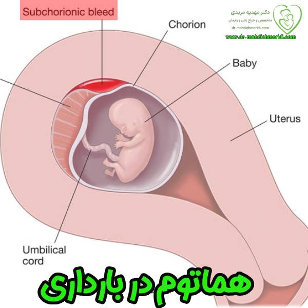 عکس هماتوم در بارداری - دکتر مهدیه مریدی
