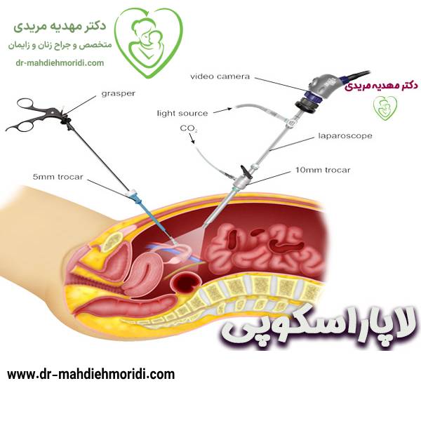 عکس لاپاراسکوپی + شیوه جراحی