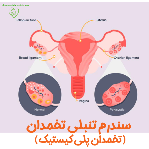 عکس تخمدان پلی کیستیک - دکتر مهدیه مریدی
