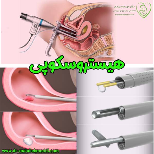 هیستروسکوپی _ دکتر مهدیه مریدی