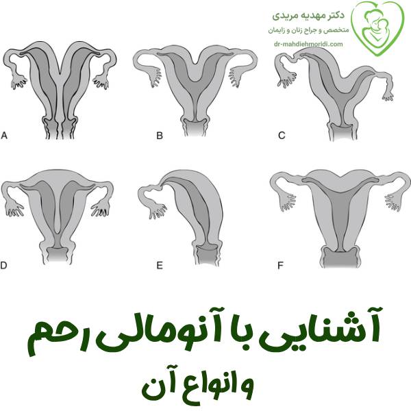 آشنایی با آنومالی رحم و انواع آن