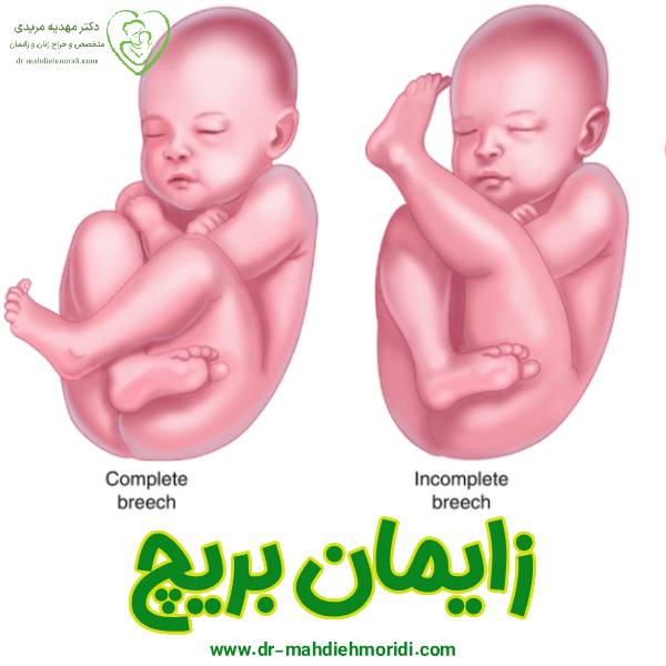 زایمان بریچ - دکتر مهدیه مریدی