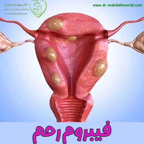 عکس فیبروم رحم - دکتر مهدیه مریدی