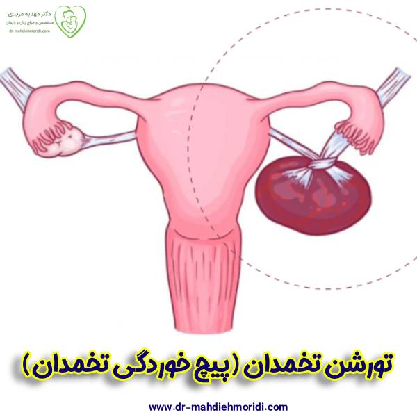 پیچ خوردگی تخمدان- تورشن تخمدان و جراحی درمانی آن - دکتر مهدیه مریدی